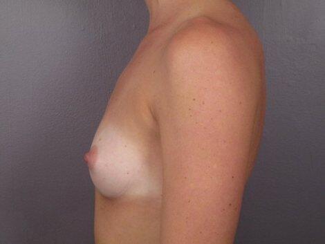 Breast Augmentation Before & After Image