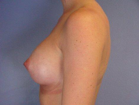 Breast Augmentation Before & After Image