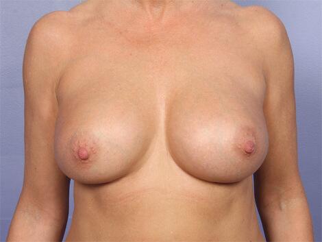 Breast Augmentation Before & After Image