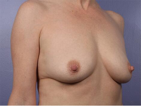 Breast Augmentation Before & After Image