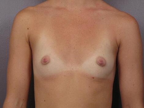 Breast Augmentation Before & After Image