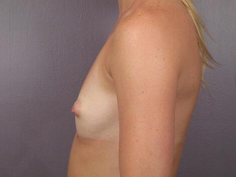 Breast Augmentation Before & After Image