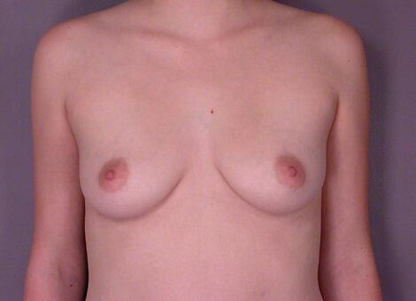 Breast Augmentation Before & After Image