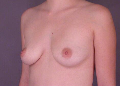 Breast Augmentation Before & After Image