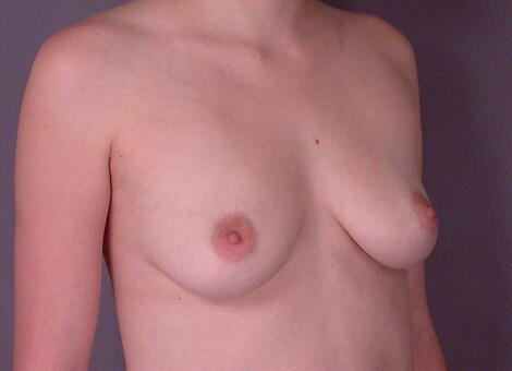 Breast Augmentation Before & After Image