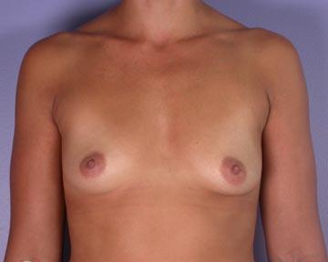 Breast Augmentation Before & After Image