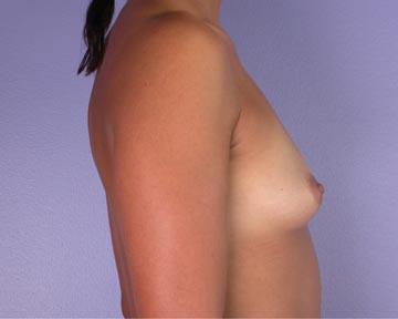 Breast Augmentation Before & After Image