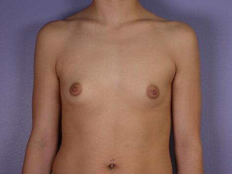 Breast Augmentation Before & After Image