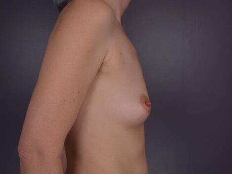 Breast Augmentation Before & After Image