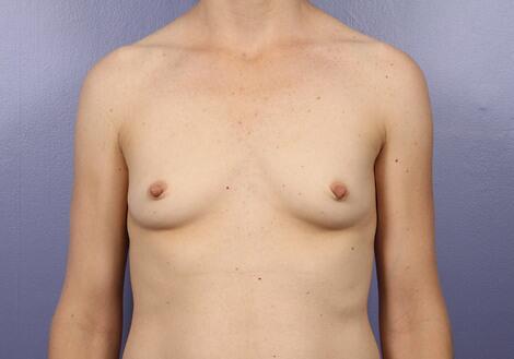 Breast Augmentation Before & After Image