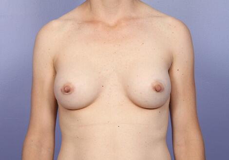 Breast Augmentation Before & After Image