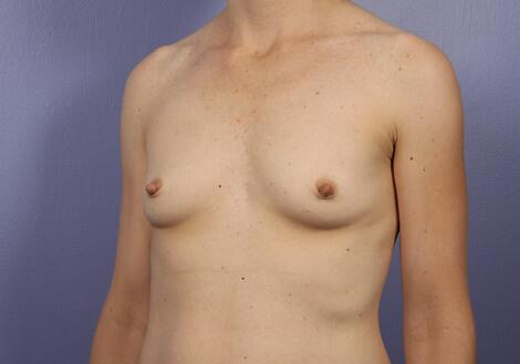 Breast Augmentation Before & After Image