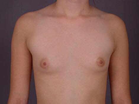 Breast Augmentation Before & After Image