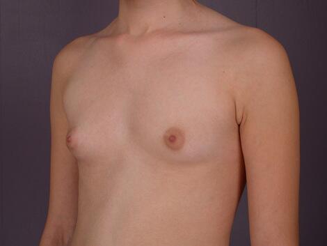 Breast Augmentation Before & After Image