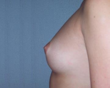 Breast Augmentation Before & After Image