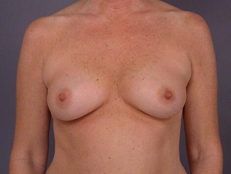 Breast Augmentation Before & After Image