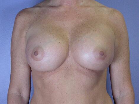 Breast Augmentation Before & After Image