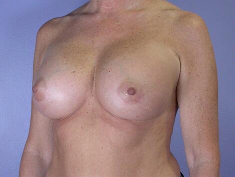 Breast Augmentation Before & After Image