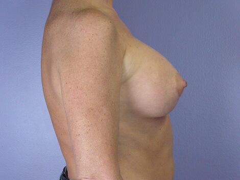 Breast Augmentation Before & After Image