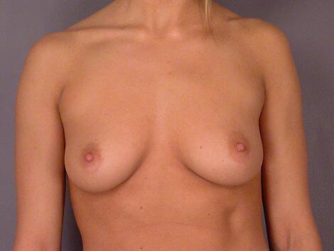 Breast Augmentation Before & After Image