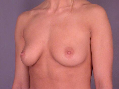 Breast Augmentation Before & After Image