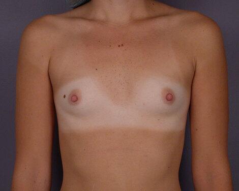 Breast Augmentation Before & After Image