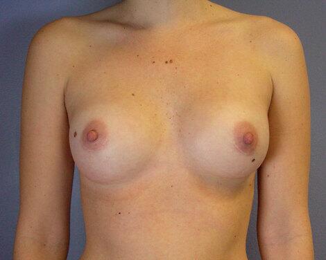 Breast Augmentation Before & After Image