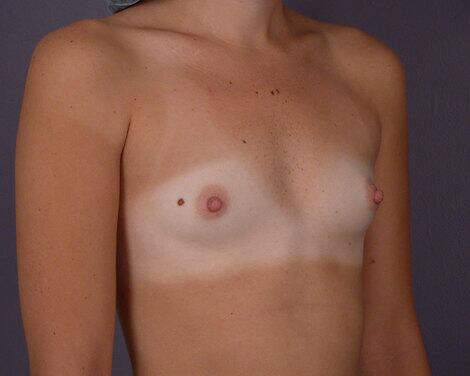 Breast Augmentation Before & After Image