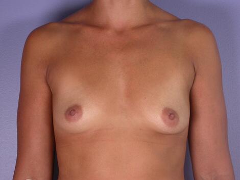 Breast Augmentation Before & After Image