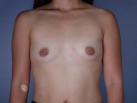 Breast Augmentation Before & After Image