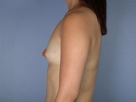 Breast Augmentation Before & After Image