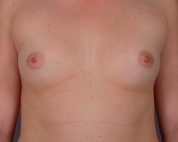 Breast Augmentation Before & After Image