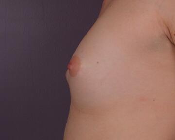 Breast Augmentation Before & After Image