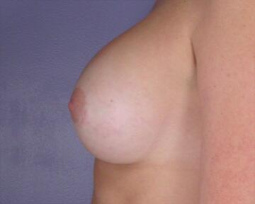 Breast Augmentation Before & After Image