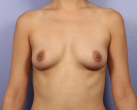 Breast Augmentation Before & After Image