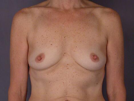 Breast Augmentation Before & After Image