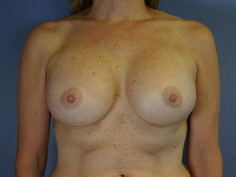 Breast Augmentation Before & After Image