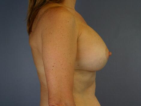 Breast Augmentation Before & After Image