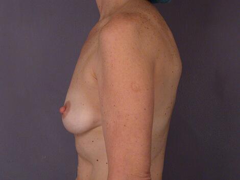 Breast Augmentation Before & After Image