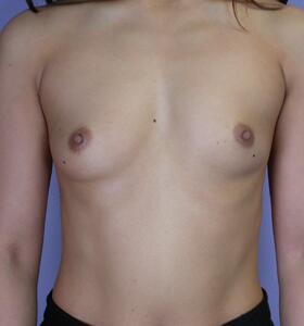 Breast Augmentation Before & After Image