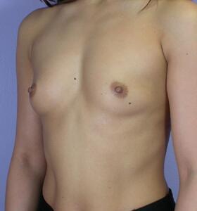 Breast Augmentation Before & After Image