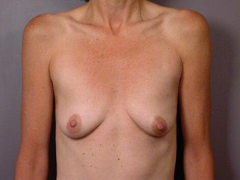 Breast Augmentation Before & After Image