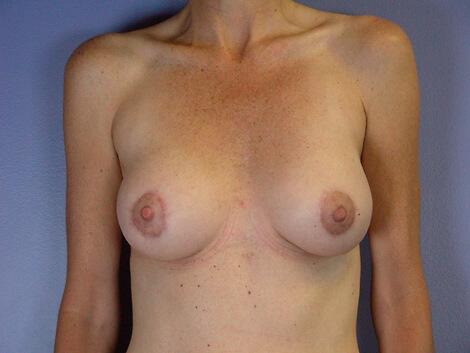 Breast Augmentation Before & After Image