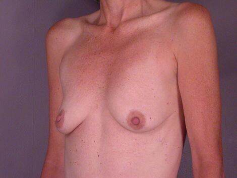 Breast Augmentation Before & After Image