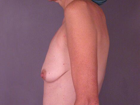 Breast Augmentation Before & After Image