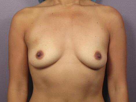 Breast Augmentation Before & After Image