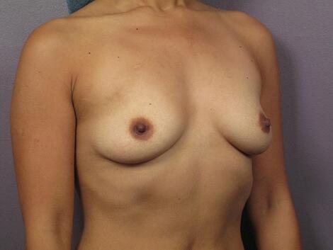 Breast Augmentation Before & After Image