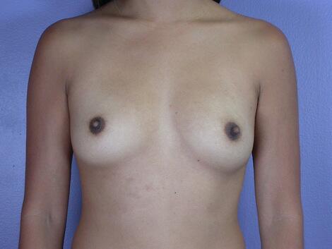 Breast Augmentation Before & After Image