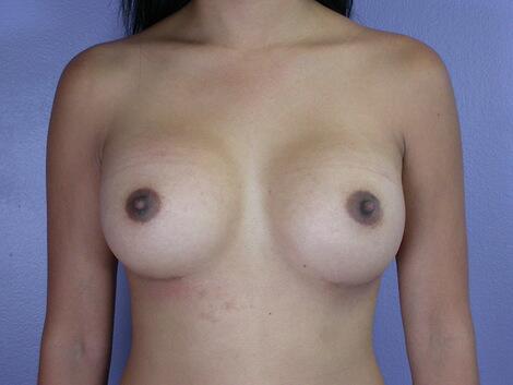 Breast Augmentation Before & After Image