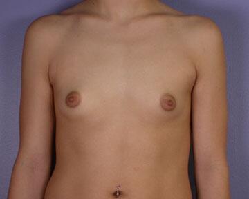 Breast Augmentation Before & After Image